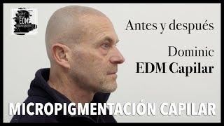 Antes y después de la micropigmentación capilar de Dominic en EDM Capilar (Marbella)