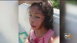 5-Year-Old Girl Who Was Attacked With Glass Bottle Is Recovering At Home